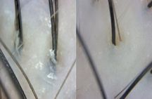  15 Step Stem Cell Scalp Treatment in Seoul